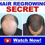 Hair Loss Causes Treatments