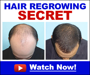 Hair Loss Causes Treatments